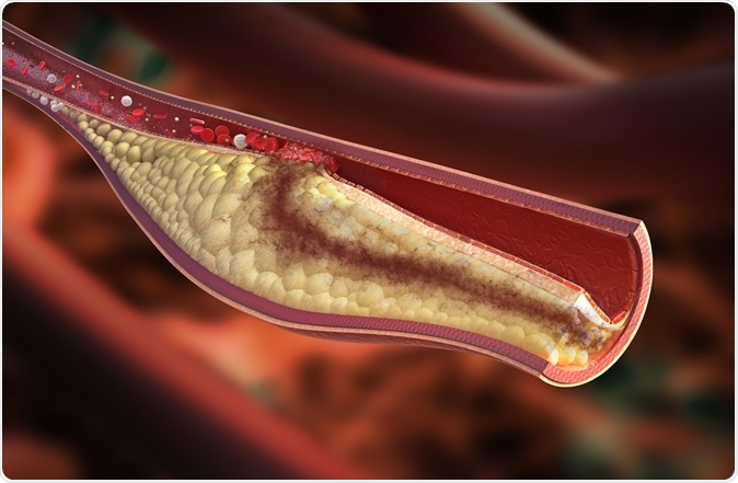 Atherosclerotic plaque development. Image Credit: Rocos / Shutterstock