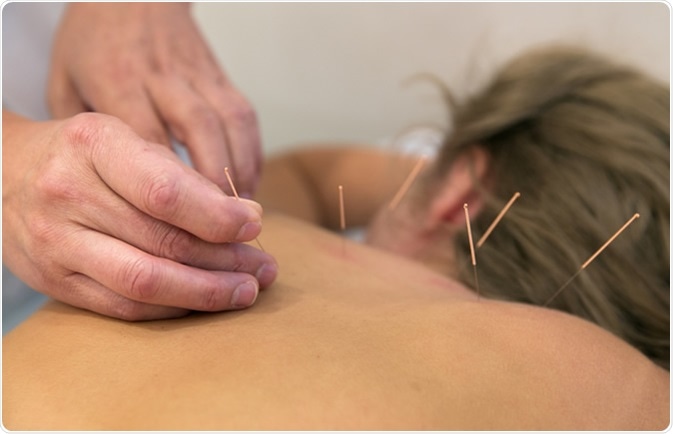 Acupuncture needles on back. Image Credit: Valery Kraynov / Shutterstock