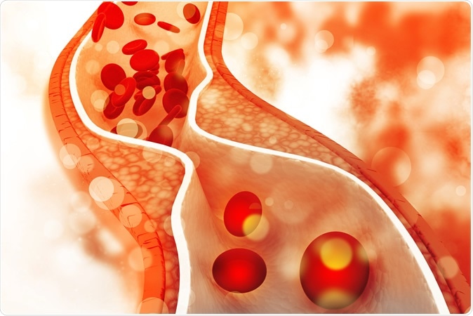 Cholesterol plaque in artery. Hywards / Shutterstock