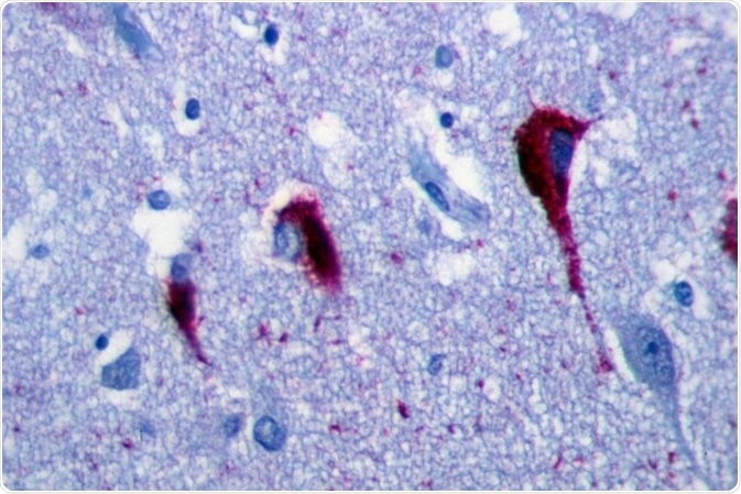 Immunohistochemistry of hippocampus of Alzheimer’s Disease patient shows neurofibrillary tangles.