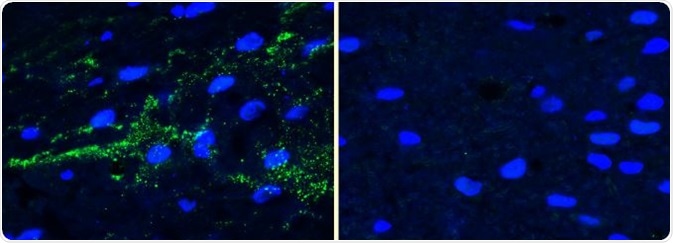 IHC analysis using alpha synucleinpSer129 antibody (SPC-742) of mouse brain injected with alpha synucleinAAV vector (L). Control (R).