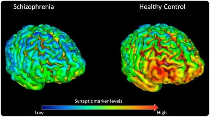 PET brain scans showing that 18 healthy volunteers (right) have on average higher levels (shown by yellow-red) of synapse marker protein SV2A than 18 participants with schizophrenia (left). Image Credit: E. Onwordi at MRC London Institute of Medical Sciences