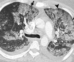 Pulmonary imaging key to diagnosing vaping-related lung damage