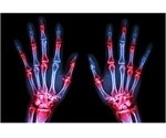 Arginine depletion could form the basis for potential rheumatoid arthritis therapies