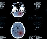 Novel artificial intelligence algorithm helps detect brain tumor