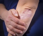 Holistic Approaches to Psoriasis Treatment