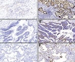 Researchers assess molecular basis of SARS-CoV-2 severity and poor outcomes in lung disease