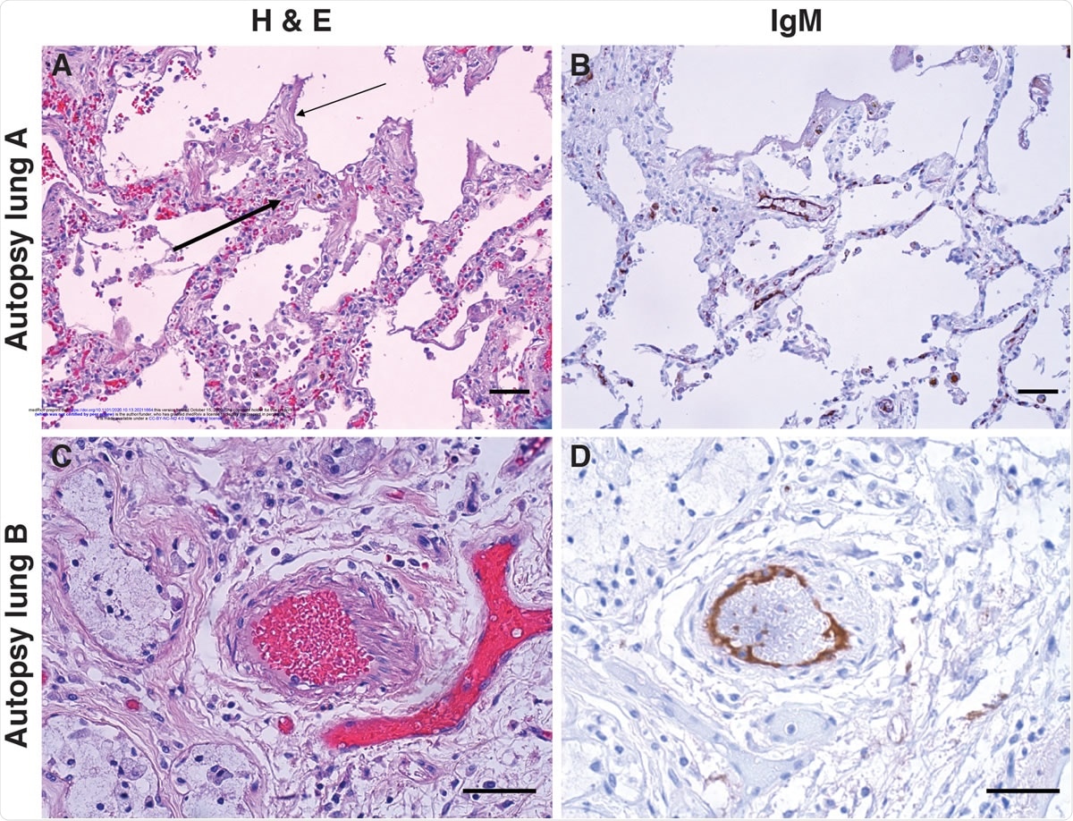 IgM deposition on endothelium in COVID-19 lung. Lung paraffin sections from two autopsy patients (lung A, upper panels; lung B, lower panels) were stained with hematoxylin and eosin (A & C) or with an anti-IgM antibody (B & D). A: A section of the left upper lobe of the lung shows a widened interstitium with capillaries showing reactive endothelium (thick arrow). There are hyaline membranes lining alveolar spaces (thin arrow), consistent with the exudative phase of diffuse alveolar damage (acute lung injury). B: Anti-IgM immunohistochemical staining of the same tissue highlights capillary endothelium in that area. C: A small artery of a bronchiole stained with hematoxylin and eosin, with (D) endothelial staining for anti-IgM. Size bars represent 50 microns.