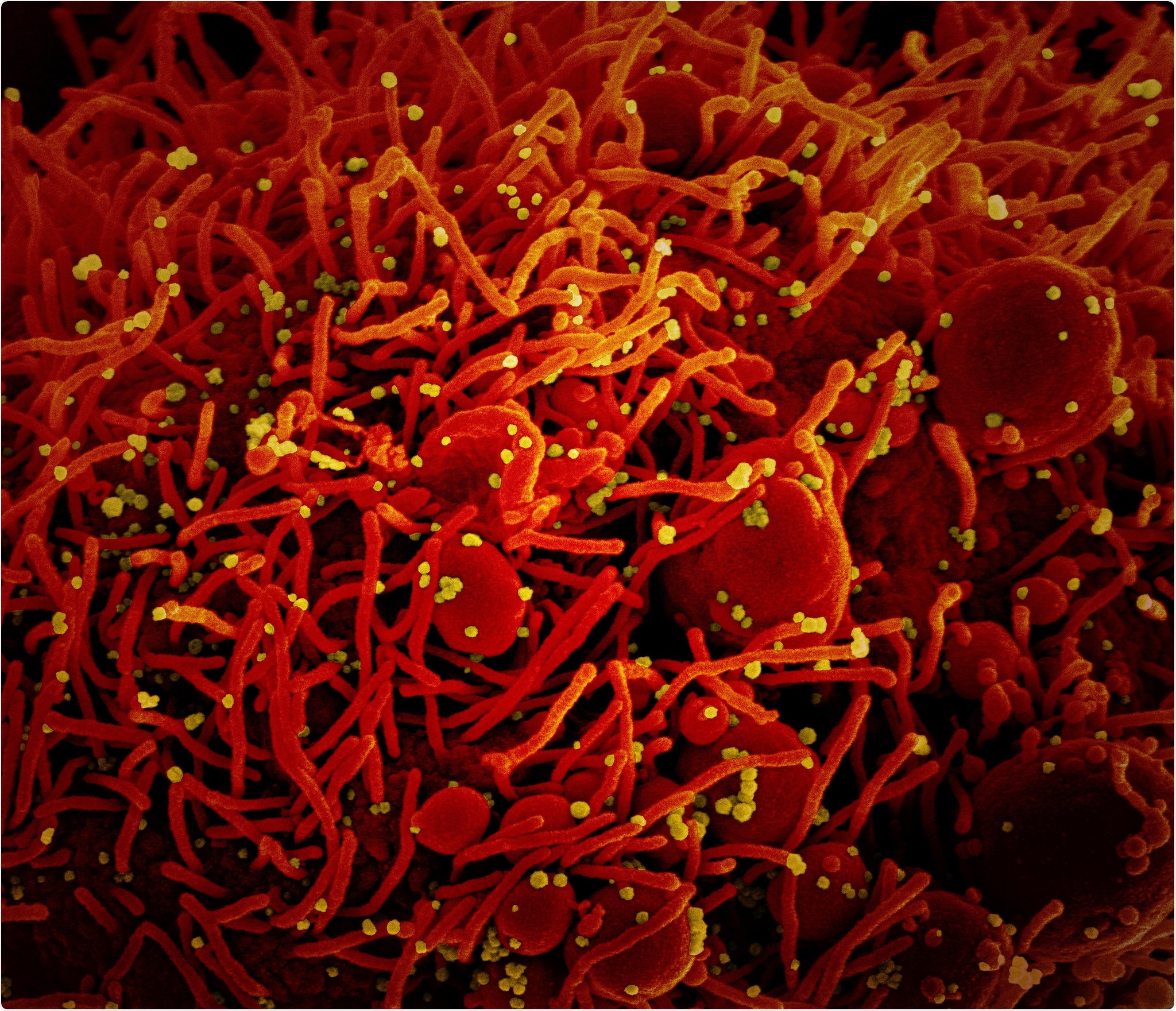 olorized scanning electron micrograph of an apoptotic cell (red) infected with SARS-COV-2 virus particles (yellow), isolated from a patient sample. Image captured at the NIAID Integrated Research Facility (IRF) in Fort Detrick, Maryland. Credit: NIAID
