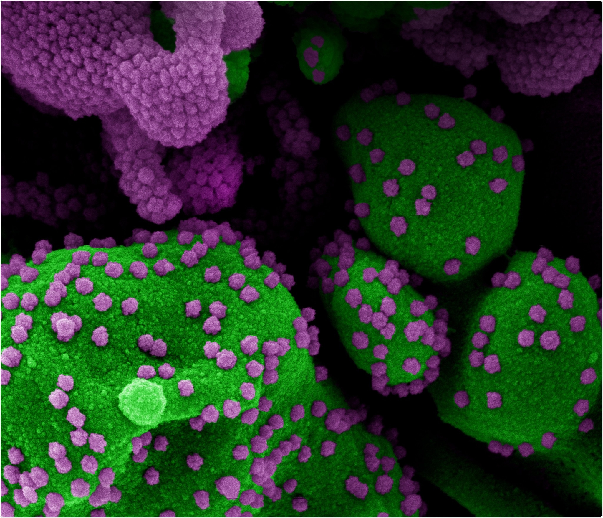 Colorized scanning electron micrograph of an apoptotic cell (green) heavily infected with SARS-CoV-2 virus particles (purple), isolated from a patient sample. Image at the NIAID Integrated Research Facility (IRF) in Fort Detrick, Maryland. Credit: NIAID