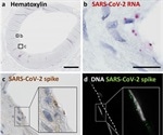 SARS-CoV-2 infection of carotid arteries may explain vascular involvement in COVID-19