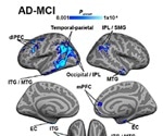 Impaired blood flow to brain regions linked with tau buildup in Alzheimer’s disease
