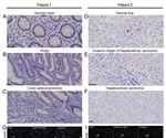 SARS-CoV-2 viral antigens found in non-pulmonary tissues in recovering patients
