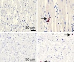 Study shows SARS-CoV-2 direct heart muscle cell infection, cell death, loss of contractility