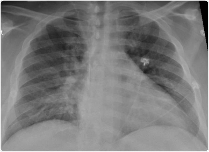 Chest X-ray of a SARS-CoV-2-positive patient exhibiting confusion and showing weakness on his left side shows pneumonia in the lower lungs.