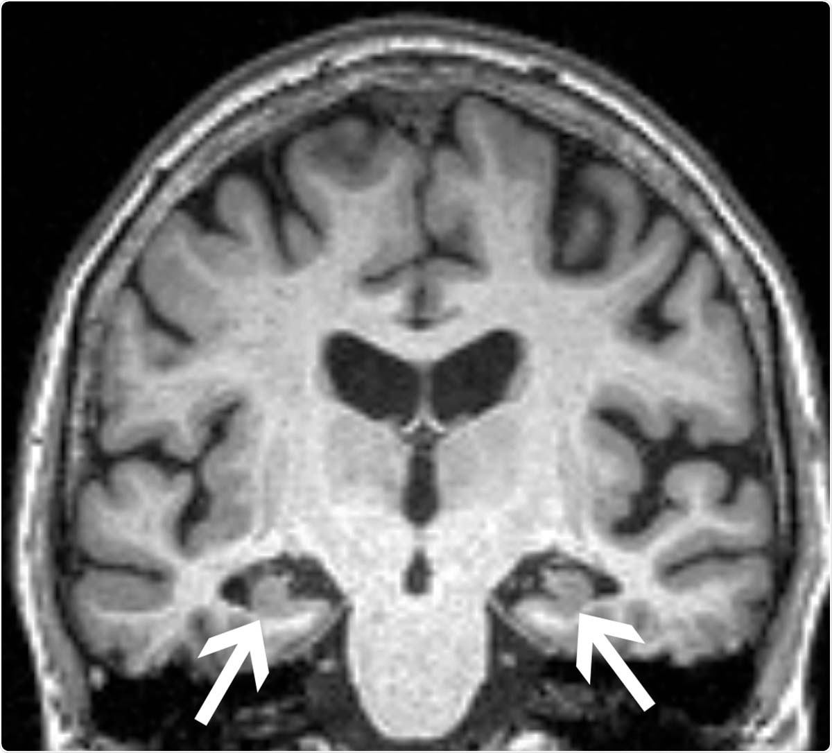Brain MRI of a 72-year-old woman shows loss of volume of the hippocampus (arrows). The patient had all three characteristics, volume loss of the hippocampi, APOE4, and anxiety, found in the study to be associated with progression from mild cognitive impairment to dementia.