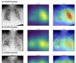 New A.I. is fast and accurate at detecting COVID-19 from chest X-rays