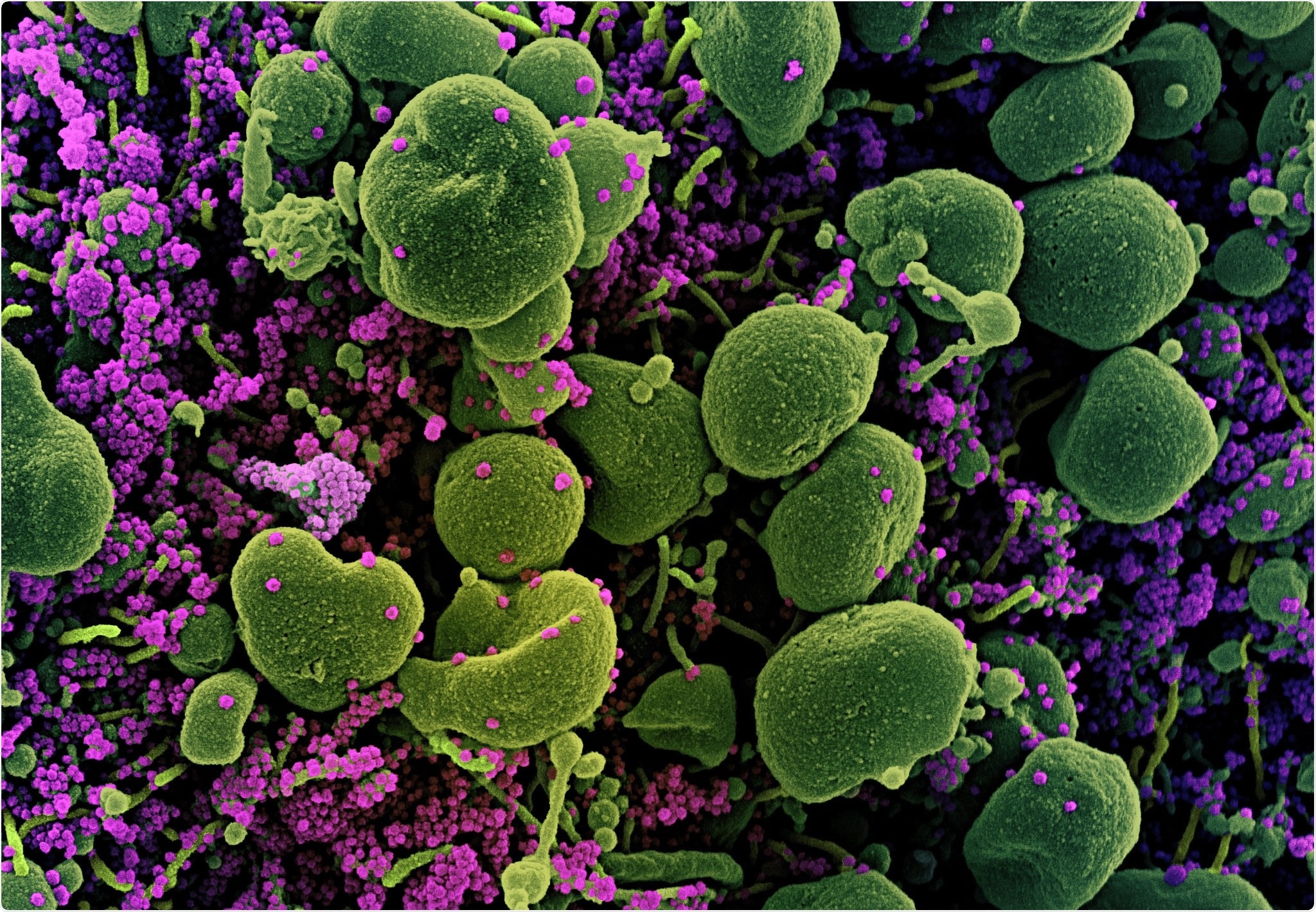 Colorized scanning electron micrograph of an apoptotic cell (green) heavily infected with SARS-CoV-2 virus particles (purple), isolated from a patient sample. Image captured at the NIAID Integrated Research Facility (IRF) in Fort Detrick, Maryland. Credit: NIAID