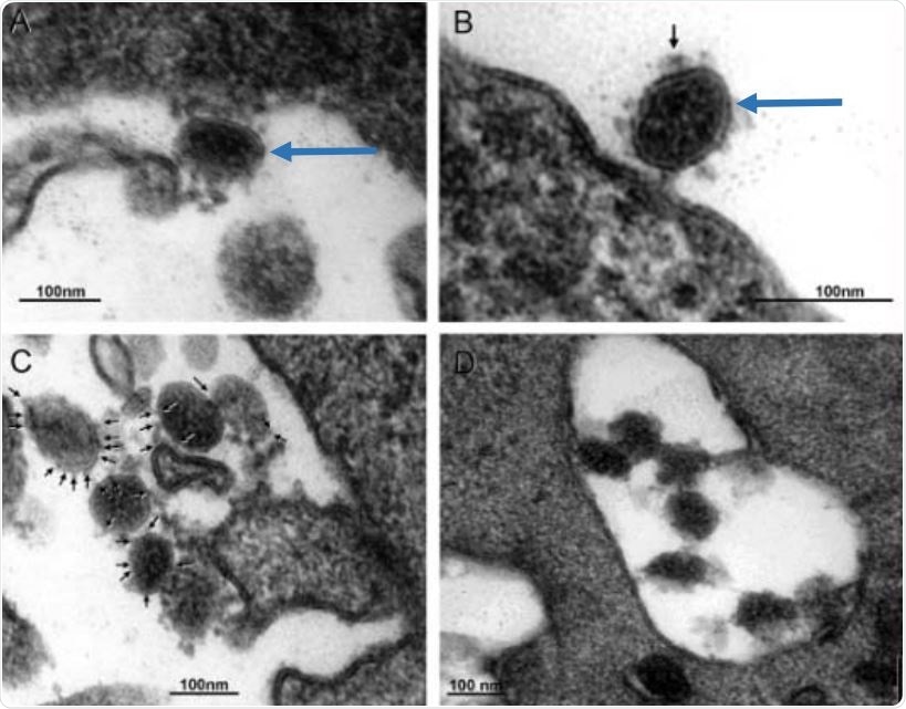 Electron microscopy of Vero cells inoculated with nasopharyngeal samples from women infected with SARS-CoV-2. Panel A, B, C, D are representative thin section electronmicrographs of the detection of SARS-CoV-2.  Long blue arrows indicate elongated and spheroid viral particles, respectively, attached to the cell border membrane in panels A and B. In panel B small arrow points to a virus spike. In panel C small arrows indicate petite and longer virus spikes. Panel D contains several viral particles inside a cytoplasmic vacuole.
