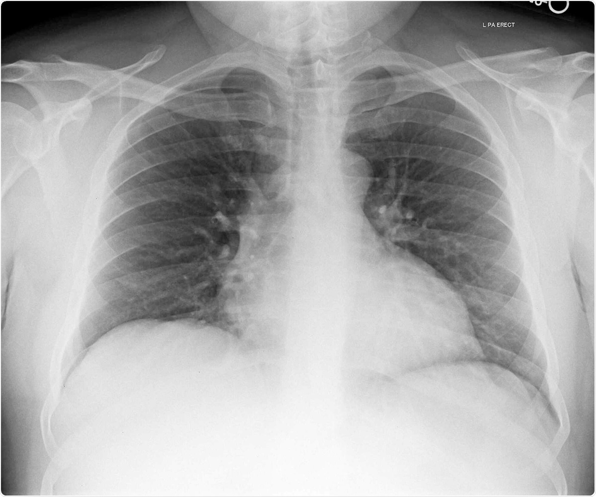 Imagen de la radiografía del pecho del haber de imagen del paciente 3./del artículo original.