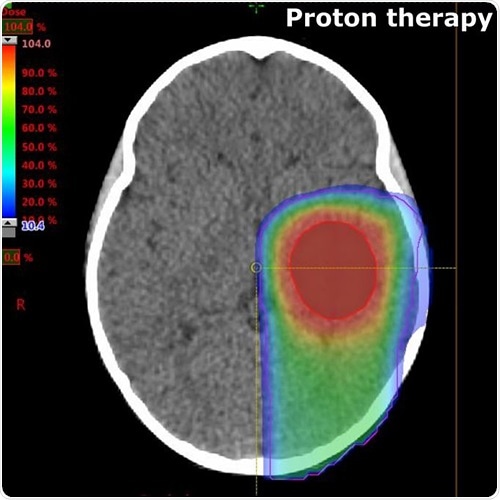 Researchers assess the risk of proton therapy for children with brain tumors