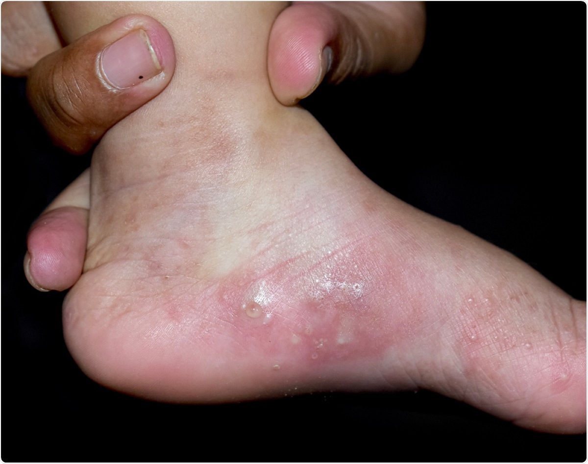 Study: Skin manifestations of COVID‐19 in children. Image Credit: Zay Nyi Nyi