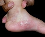 Chilblain-like skin lesions reported in adolescents and young adults during the pandemic