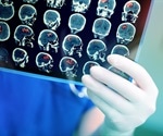 Men and women may require different brain tumor therapy, study finds