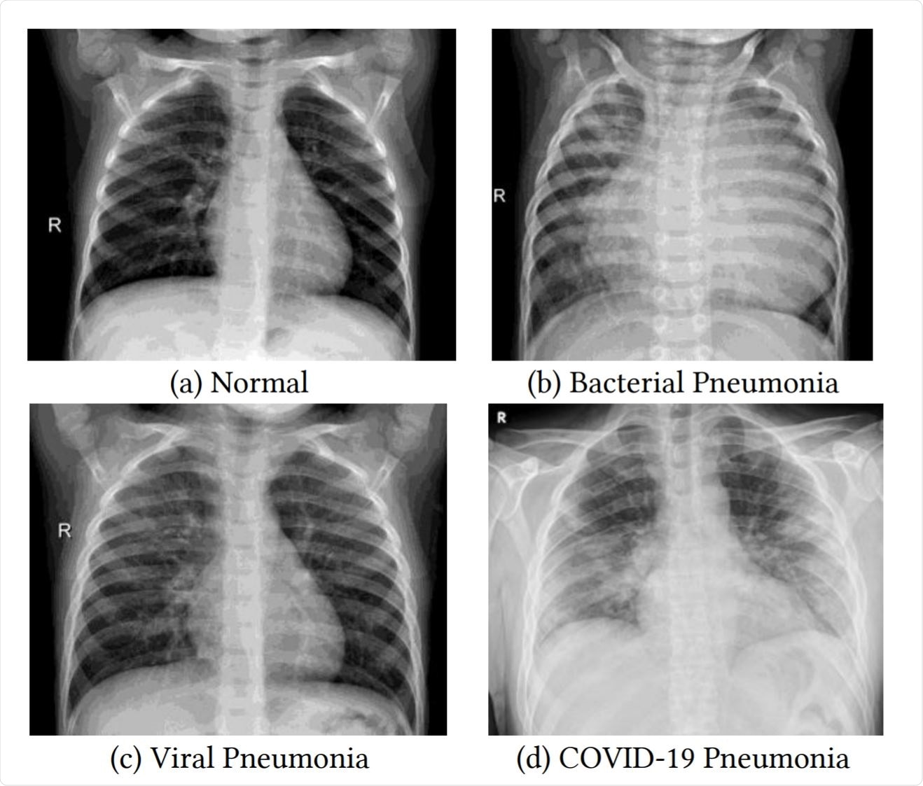 Examples of frontal-view chest X-Ray images from the datasets.