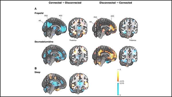 Changes in consciousness linked to the same brain network for sleep and anesthesia