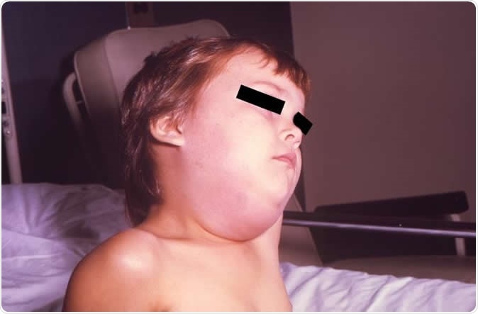 This image depicts a child with a mumps infection. Note the characteristic swollen neck region due to an enlargement of the boy’s salivary glands. Credit: CDC