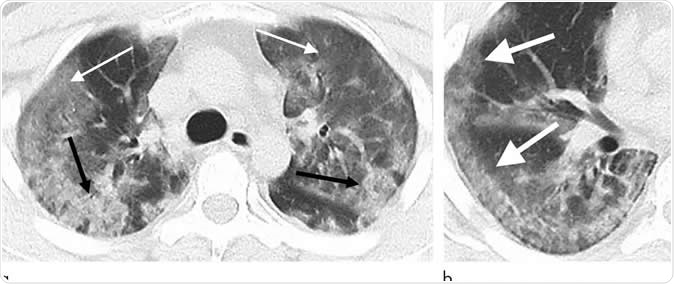 29-year old male with unknown exposure history, presenting with fever and cough, ultimately requiring intensive care unit admission. (a) Axial thin-section non-contrast CT scan shows diffuse bilateral confluent and patchy ground-glass (solid arrows) and consolidative (dashed arrows) pulmonary opacities. (b) The disease in the right middle and lower lobes has a striking peripheral distribution (arrow). Image Credit: Radiological Society of North America