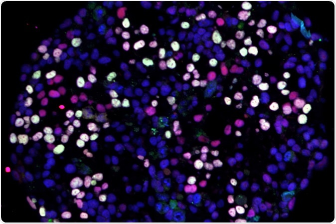 UCLA Broad Stem Cell Research Center/Cell Reports - Differentiating human pluripotent stem cells (blue) turning into human germ cells (pink and white).