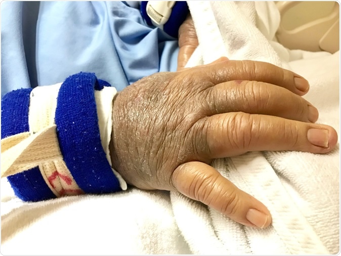 Hand swelling of kidney patient. Image Credit: MheePanda / Shutterstock