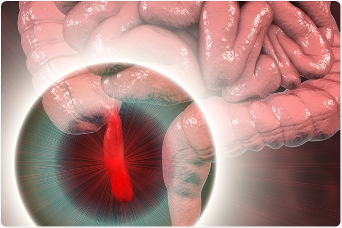 Acute appendicitis, 3D illustration showing inflamed appendix on the cecum. Image Credit: Kateryna Kon / Shutterstock