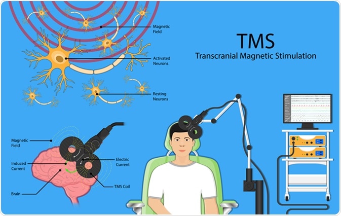Transcranial magnetic stimulation TMS. Image Credit: Rumruay / Shutterstock