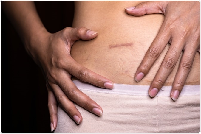 Appendicitis scar. Image Credit: Avigator Fortuner / Shutterstock