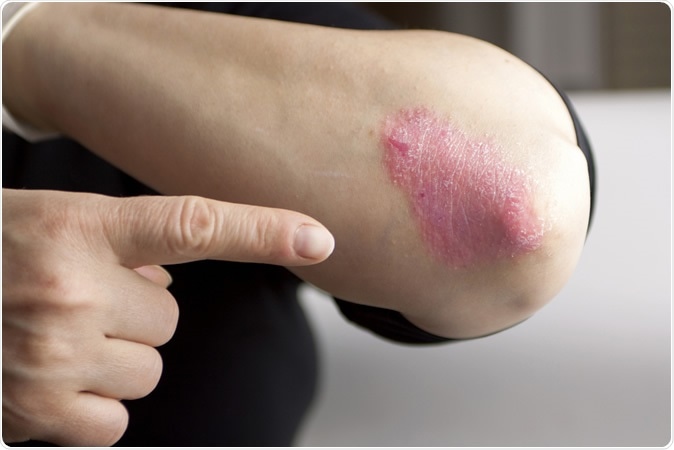 Psoriasis on elbow. Closeup. Image Credit: Hriana / Shutterstock