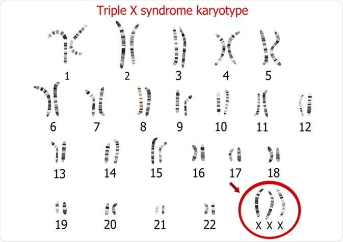 Triple X syndrome karyotype - superfemale. Image Credit: Zuzanae / Shutterstock