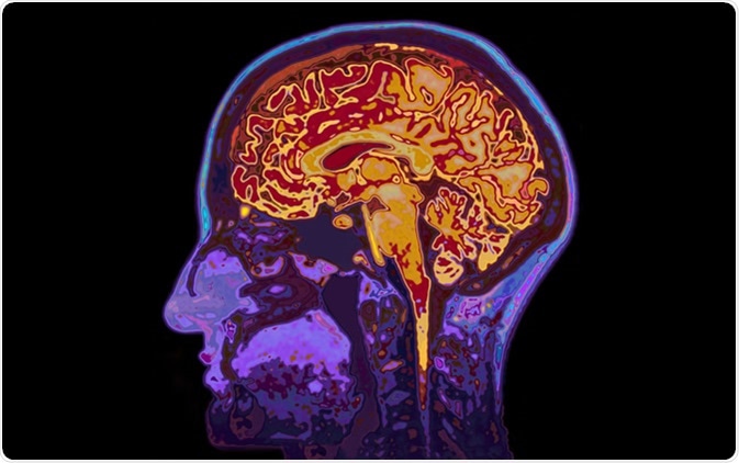 MRI Image Of Head Showing Brain. Image Credit: SpeedKingz / Shutterstock