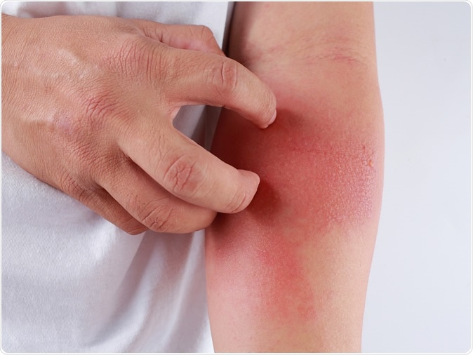 Eczema. Image Credit: TY Lim / Shutterstock