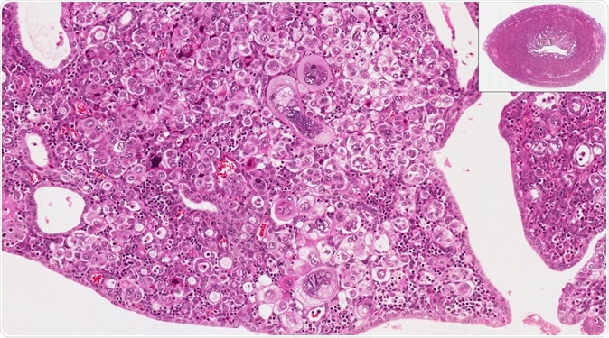 The new study from NYU Langone researchers provides an in-depth survey of the molecular players in endometrial cancer and suggests new treatment approaches. High and low power microscopic view of endometrium (uterus) to show endometrial cancer. Image Credit: vetpathologist / Shutterstock