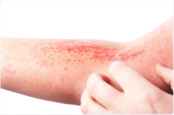 Atopic dermatitis (AD), also known as atopic eczema. This study shows that families with eczema, asthma, or allergic rhinitis should not use daily emollients to try and prevent eczema in their newborns. Image Credit: LIAL / Shutterstock