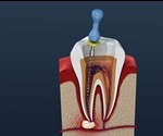 Comparing Root Canal Removal Techniques with Micro-CT