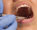 Gum disease linked to stroke