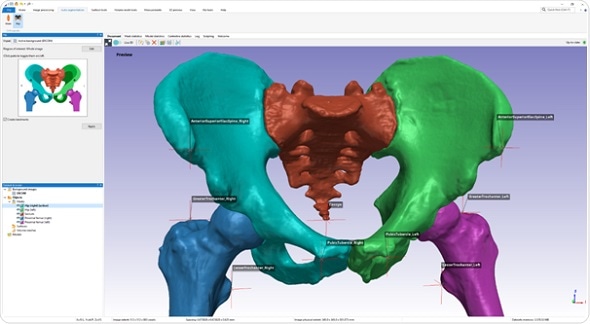 Synopsys introduces automated segmentation tool for hips and knees