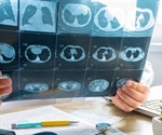 Chest CT scan best for coronavirus diagnosis