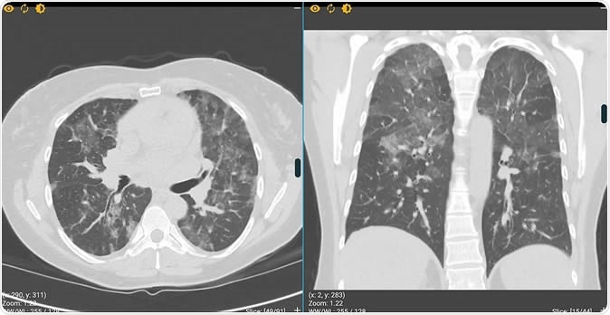 Free virtual clinical environment that helps clinicians to become better at recognising the early CT signs of COVID-19. Image Credit: DetectEd