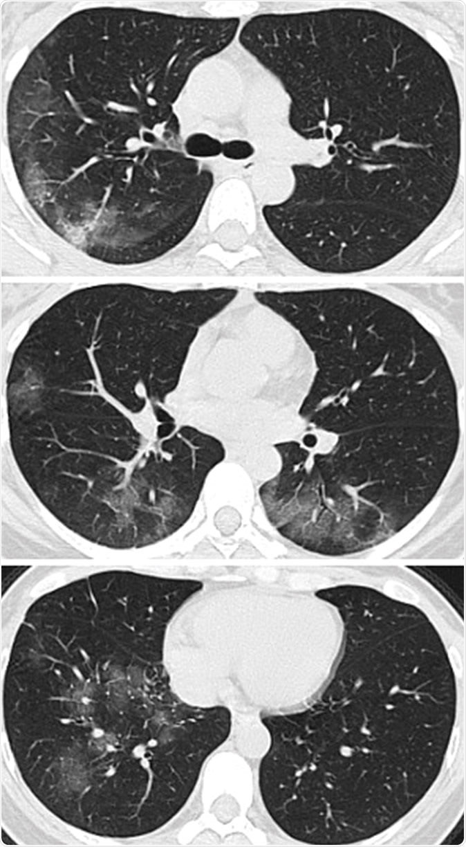 Images in a 41-year-old woman who presented with fever and positive polymerase chain reaction assay for the 2019 novel coronavirus (2019-nCoV). (a) Three representative axial thin-section chest CT images show multifocal ground glass opacities without consolidation. (b) Three-dimensional volume-rendered reconstruction shows the distribution of the ground-glass opacities (arrows). See also three-dimensional Movie (online).