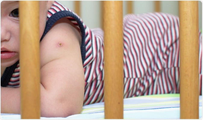 The red pop mark of BCG vaccine on the baby shoulder. Image Credit:  Nym_Pleydell / Shutterstock
